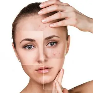 adult acne causes and treatments for skin